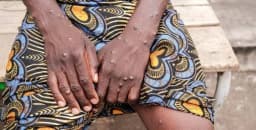 Mpox em Cabinda sob controlo