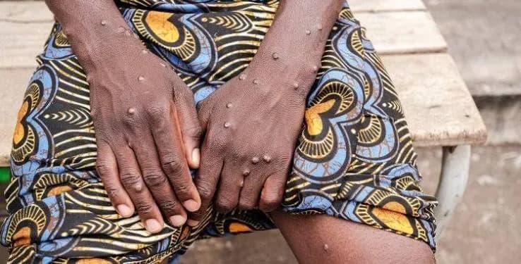 Mpox em Cabinda sob controlo