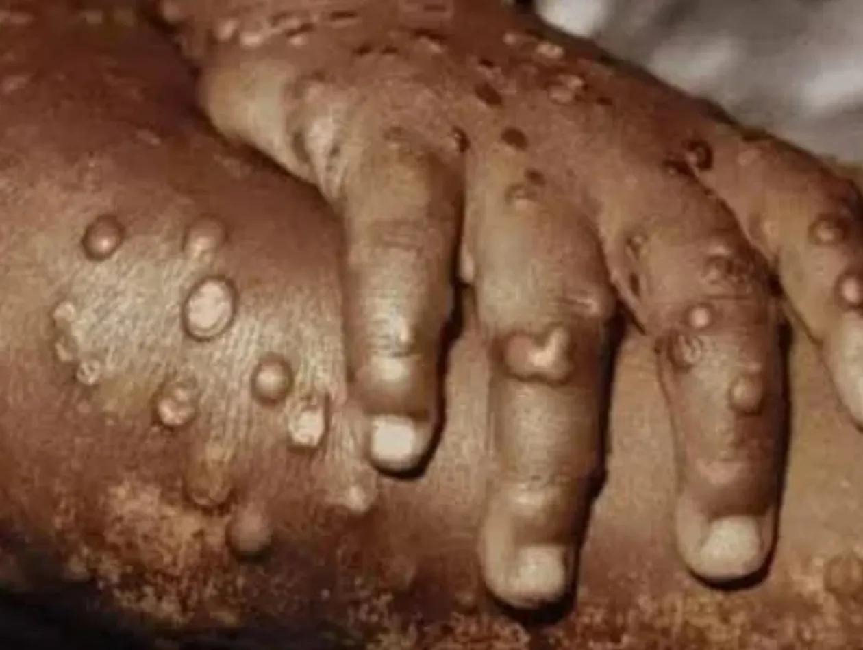 Cabinda Regista Primeira Morte por Mpox